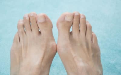Take Control Over Your Bunions
