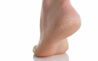 Top Tips to Stop Heel Pain Before It Starts
