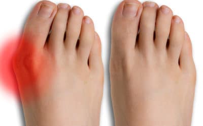 Should You Consider Bunion Surgery?