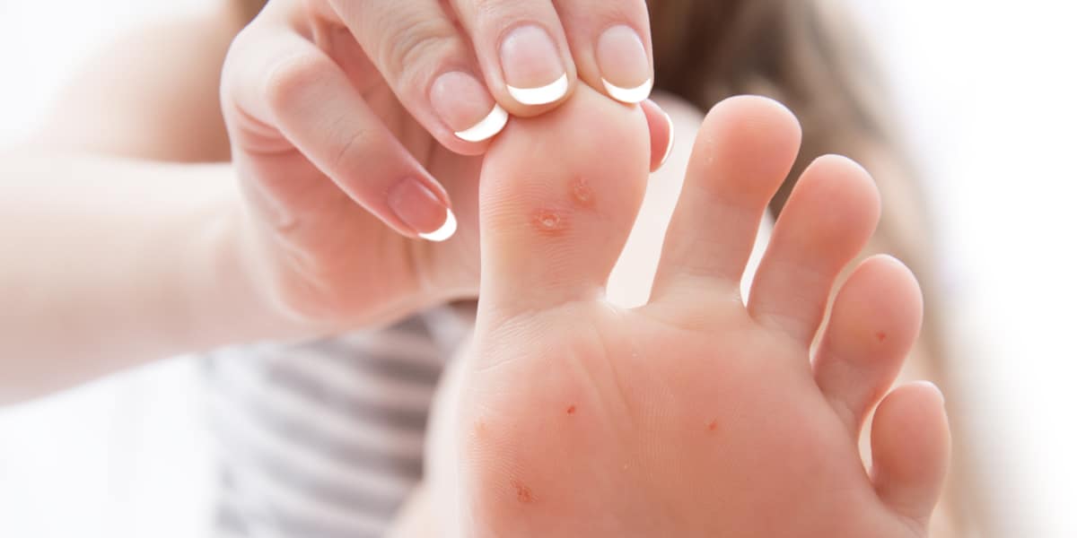 female foot with problem areas on the skin, warts