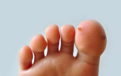 What’s the Best Way to Get Rid of Warts?