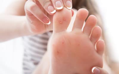 Treating Foot Warts Used to Be Miserable. Not Anymore.