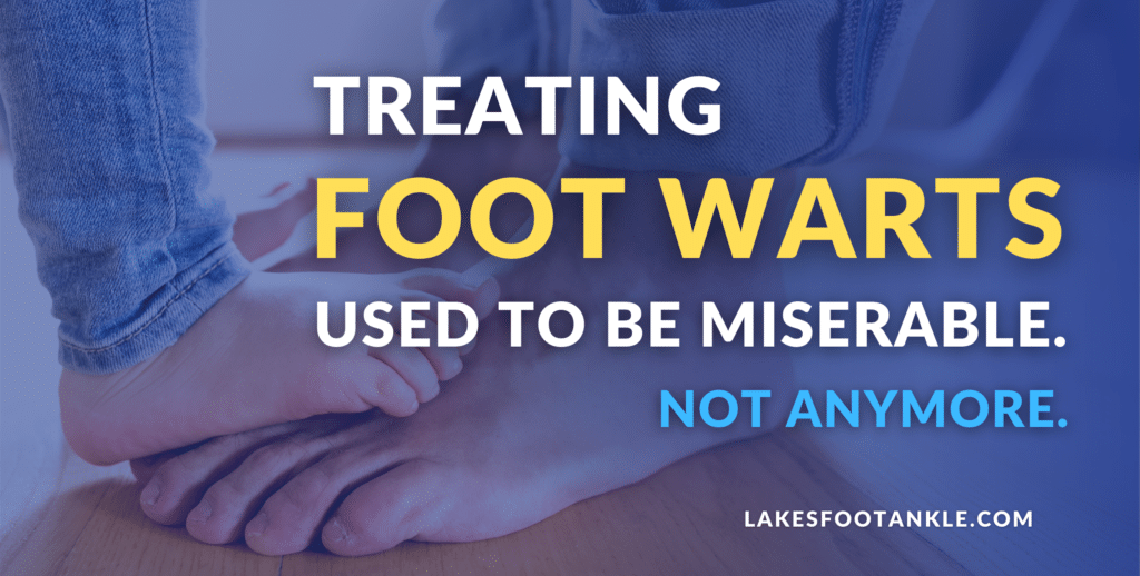 Swift Treatment for Warts